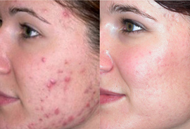 Acne Scars Treatment in Meham