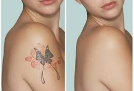 Tattoo Removal Treatment in Meham