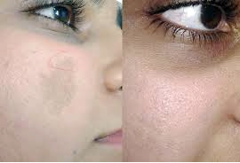 Birth Mark Removal Treatment in India