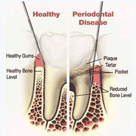 Oral Hygiene Treatment in India