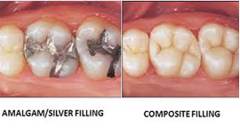 Composite Fillings Treatment in India