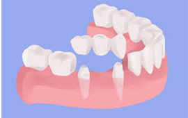 Dental Bridges Treatment in Ratia