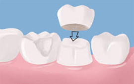 Dental Crowns Treatment in Meham