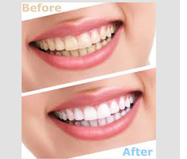 Teeth Whitening Treatment in Siwani