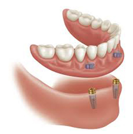 Dentures Treatment in Ambala