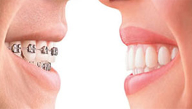 Orthodontics Treatment in Meham