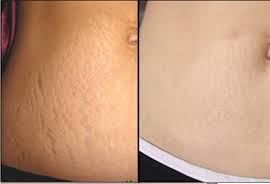 Stretch Marks Treatment in Meham