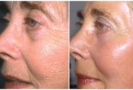 Skin Tightening Rejuvenation Treatment in Hisar